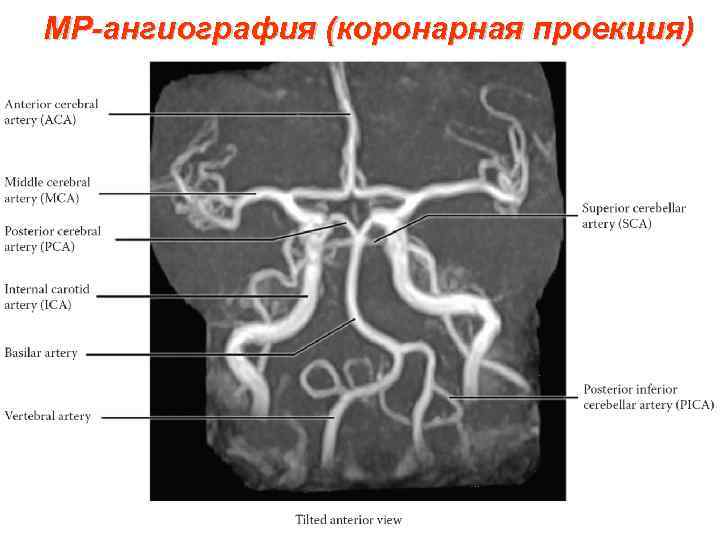 МР-ангиография (коронарная проекция) 