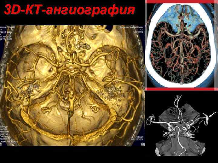 3 D-КТ-ангиография 