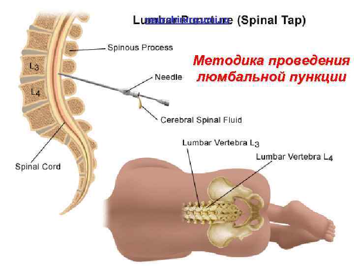 neurohirurg. umi. ru Методика проведения люмбальной пункции 