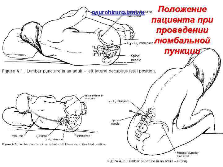 neurohirurg. umi. ru Положение пациента при проведении люмбальной пункции 