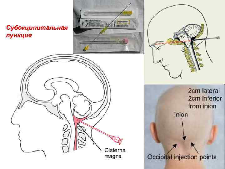 Субокципитальная пункция 