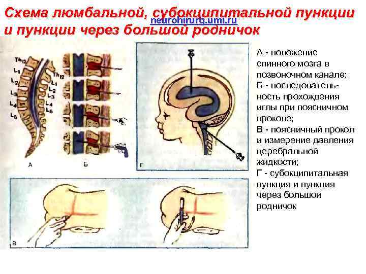 Схема люмбальной, neurohirurg. umi. ru субокципитальной пункции и пункции через большой родничок А -