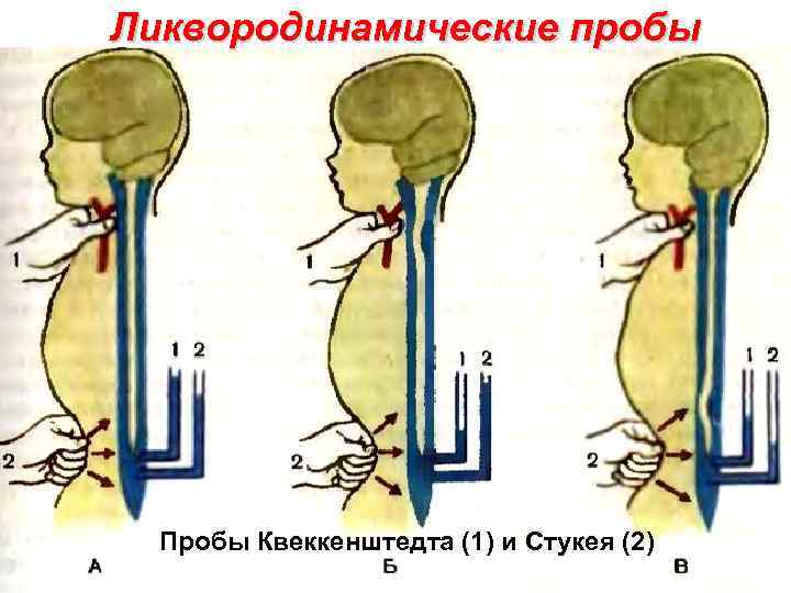 Ликвородинамические пробы Пробы Квеккенштедта (1) и Стукея (2) 