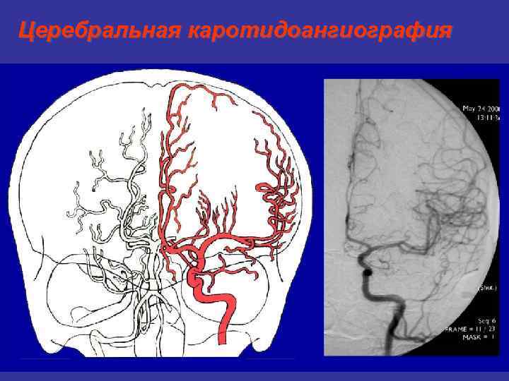 Церебральная каротидоангиография 