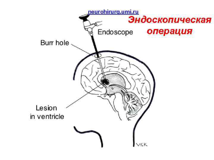 neurohirurg. umi. ru Эндоскопическая операция 