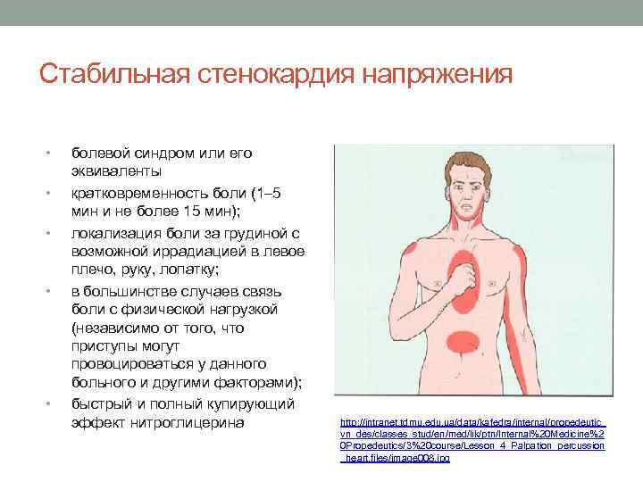 Стабильная стенокардия напряжения • • • болевой синдром или его эквиваленты кратковременность боли (1–