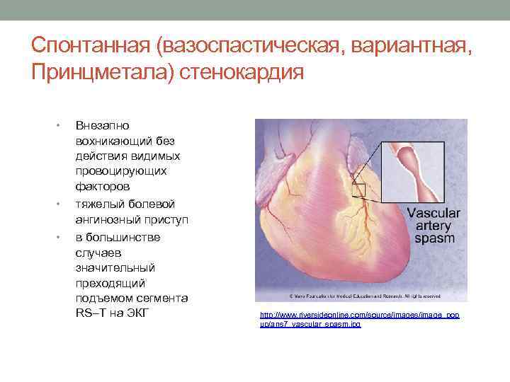 Спонтанная (вазоспастическая, вариантная, Принцметала) стенокардия • • • Внезапно вохникающий без действия видимых провоцирующих