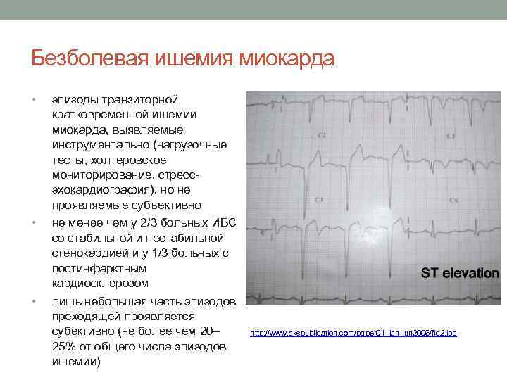 Безболевая ишемия миокарда • • • эпизоды транзиторной кратковременной ишемии миокарда, выявляемые инструментально (нагрузочные