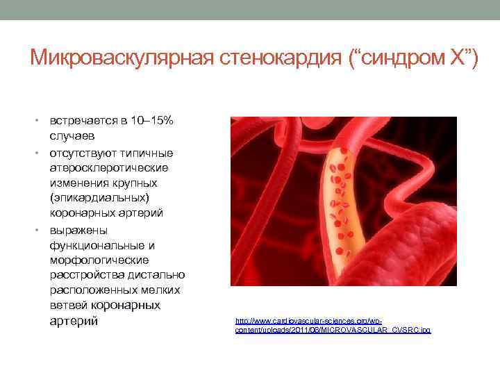 Микроваскулярная стенокардия (“синдром Х”) встречается в 10– 15% случаев • отсутствуют типичные атеросклеротические изменения