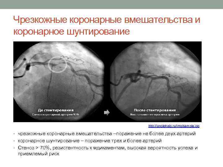 Чрезкожные коронарные вмешательства и коронарное шунтирование http: //angiohelp. ru/img/sample. jpg • чрезкожные коронарные вмешательства