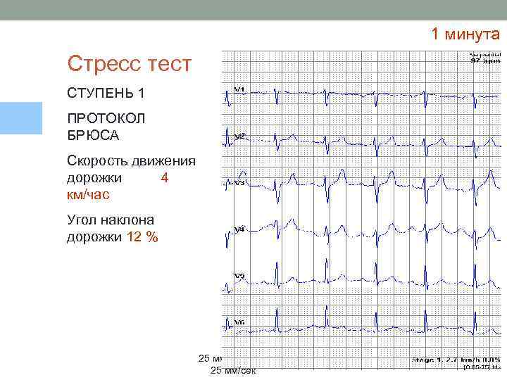 1 минута Стресс тест СТУПЕНЬ 1 ПРОТОКОЛ БРЮСА Скорость движения дорожки 4 км/час Угол