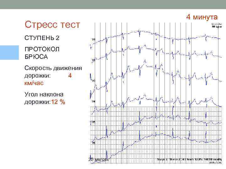 4 минута Стресс тест СТУПЕНЬ 2 ПРОТОКОЛ БРЮСА Скорость движения дорожки: 4 км/час Угол