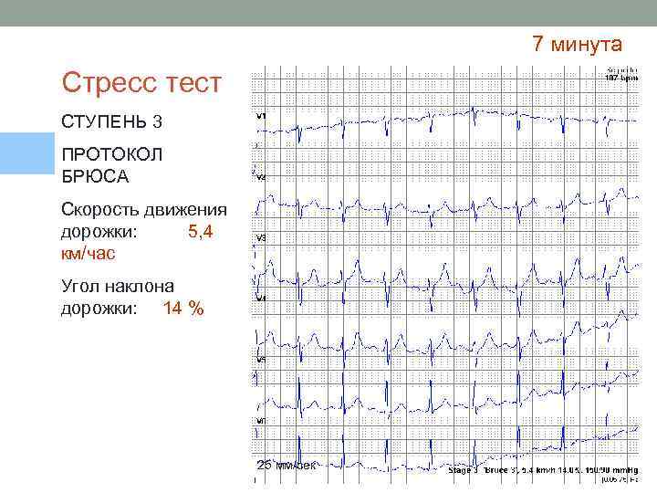 7 минута Стресс тест СТУПЕНЬ 3 ПРОТОКОЛ БРЮСА Скорость движения дорожки: 5, 4 км/час