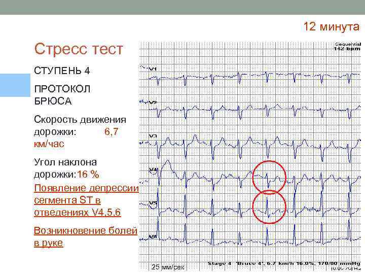 12 минута Стресс тест СТУПЕНЬ 4 ПРОТОКОЛ БРЮСА Скорость движения дорожки: 6, 7 км/час