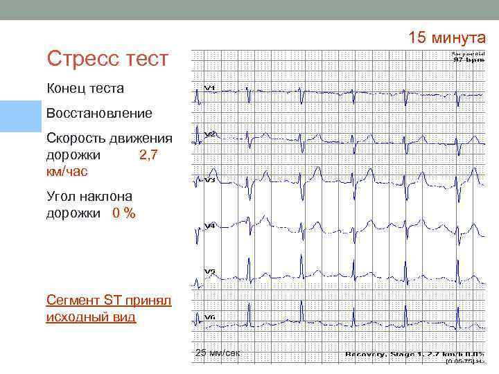 15 минута Стресс тест Конец теста Восстановление Скорость движения дорожки 2, 7 км/час Угол