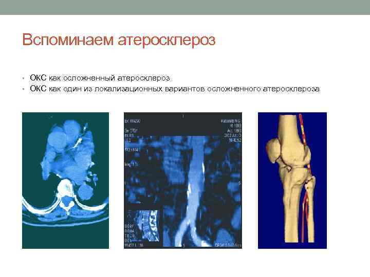 Вспоминаем атеросклероз • ОКС как осложненный атеросклероз • ОКС как один из локализационных вариантов