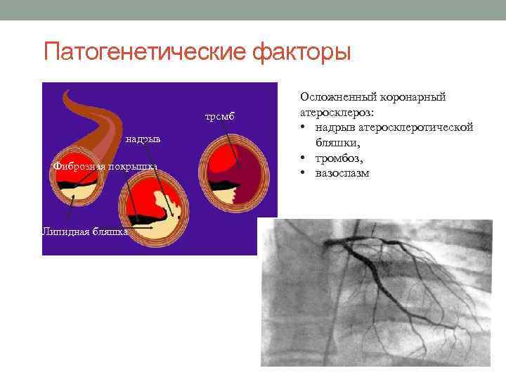 Патогенетические факторы тромб надрыв Фиброзная покрышка Липидная бляшка Осложненный коронарный атеросклероз: • надрыв атеросклеротической