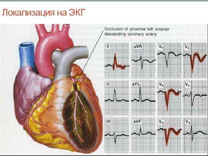 Локализация на ЭКГ 