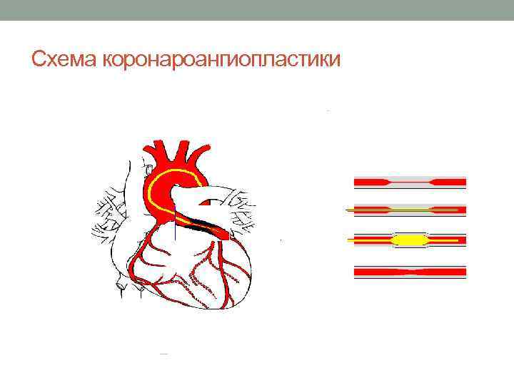 Схема коронароангиопластики 