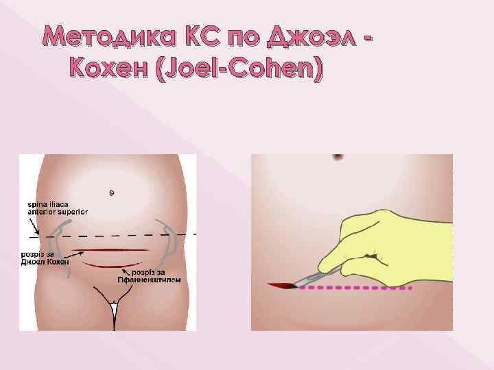 Методика КС по Джоэл Кохен (Joel-Cohen) 