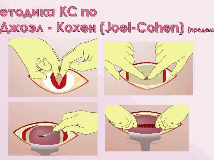 етодика Методика КС по Джоэл - Кохен (Joel-Cohen) (продолж 