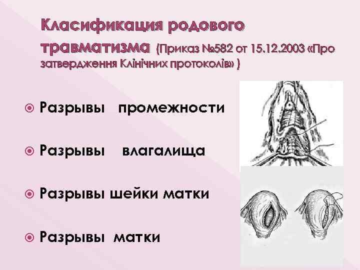 Класификация родового травматизма (Приказ № 582 от 15. 12. 2003 «Про затвердження Клінічних протоколів»