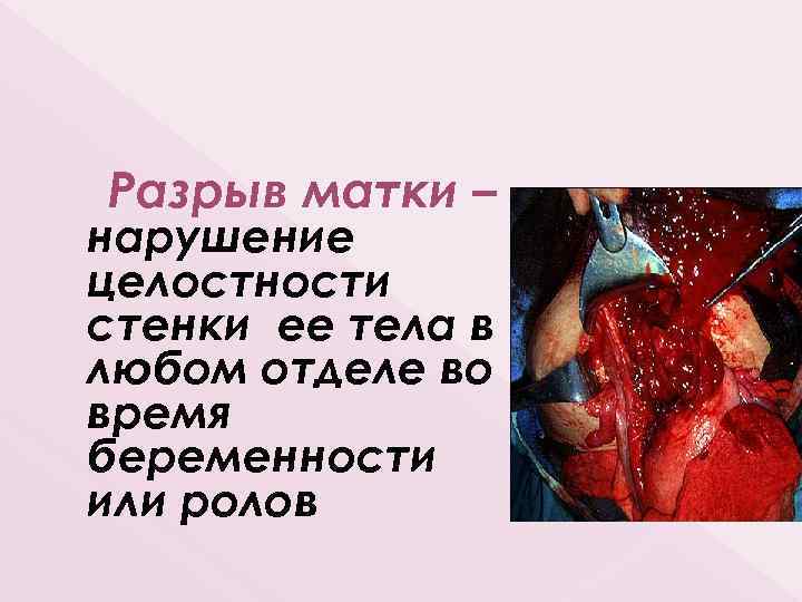 Разрыв матки – нарушение целостности стенки ее тела в любом отделе во время беременности