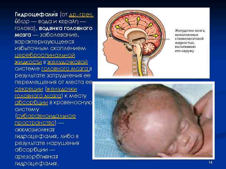 Гидроцефали я (от др. -греч. ὕδωρ — вода и κεφαλή — голова), водянка головного
