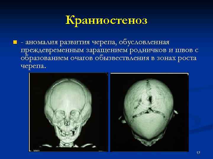 Краниостеноз n - аномалия развития черепа, обусловленная преждевременным заращением родничков и швов с образованием