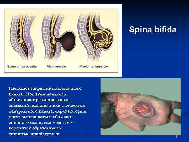 Spina bifida Неполное закрытие позвоночного канала. Под этим понятием объединяют различные виды аномалий позвоночника