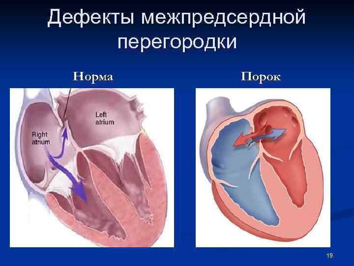 Аневризма межпредсердной перегородки