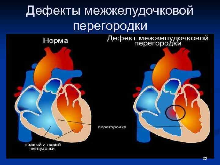 Дефекты межжелудочковой перегородки 20 