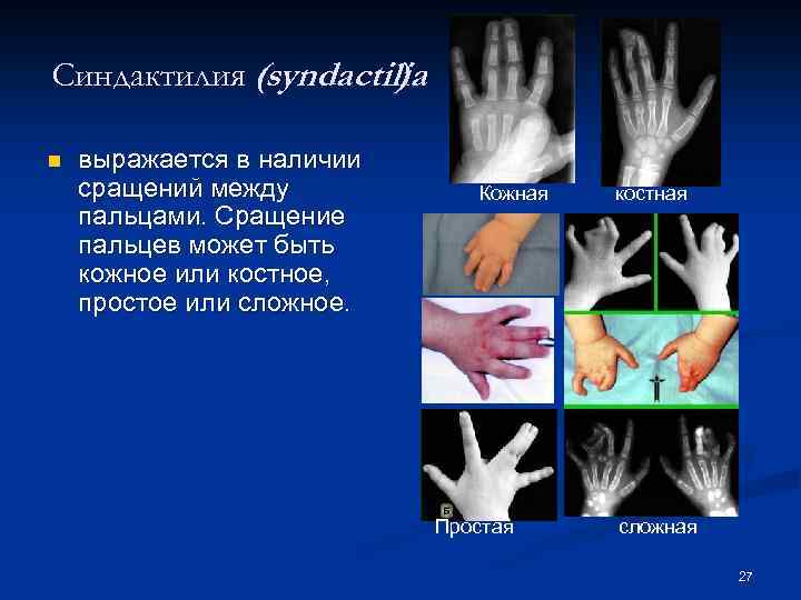 Синдактилия (syndactilia ) n выражается в наличии сращений между пальцами. Сращение пальцев может быть