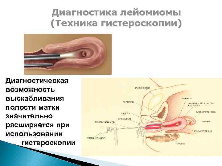 Диагностика лейомиомы (Техника гистероскопии) Диагностическая возможность выскабливания полости матки значительно расширяется при использовании гистероскопии