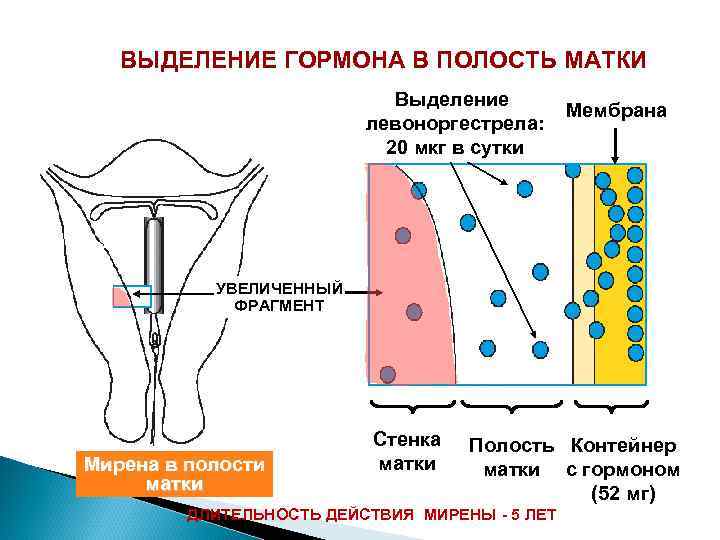 ВЫДЕЛЕНИЕ ГОРМОНА В ПОЛОСТЬ МАТКИ Выделение левоноргестрела: 20 мкг в сутки Мембрана УВЕЛИЧЕННЫЙ ФРАГМЕНТ