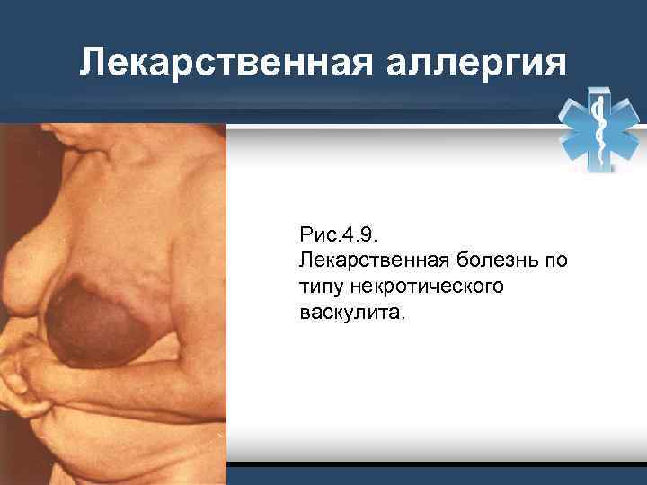 Лекарственная аллергия Рис. 4. 9. Лекарственная болезнь по типу некротического васкулита. 