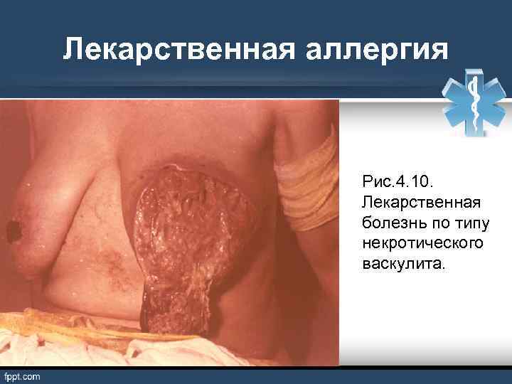 Лекарственная аллергия Рис. 4. 10. Лекарственная болезнь по типу некротического васкулита. 