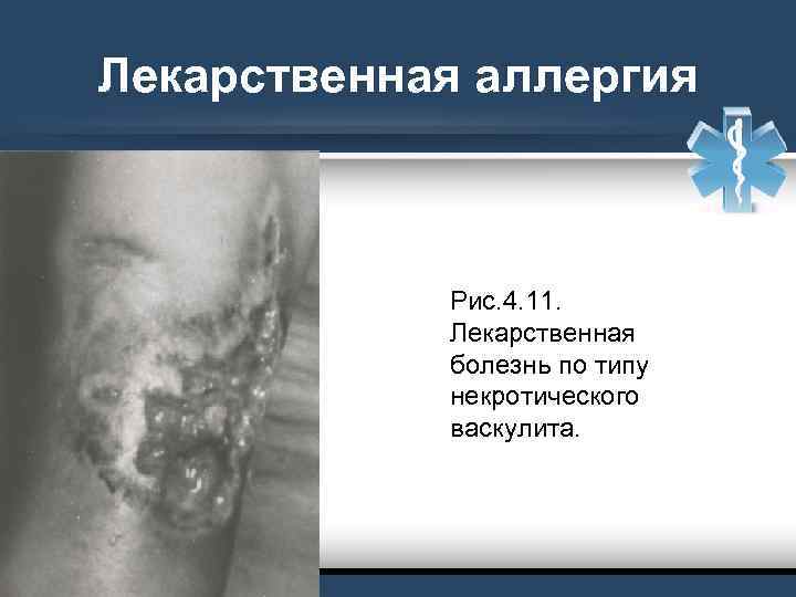Лекарственная аллергия Рис. 4. 11. Лекарственная болезнь по типу некротического васкулита. 