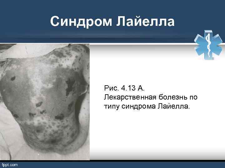 Синдром Лайелла Рис. 4. 13 А. Лекарственная болезнь по типу синдрома Лайелла. 