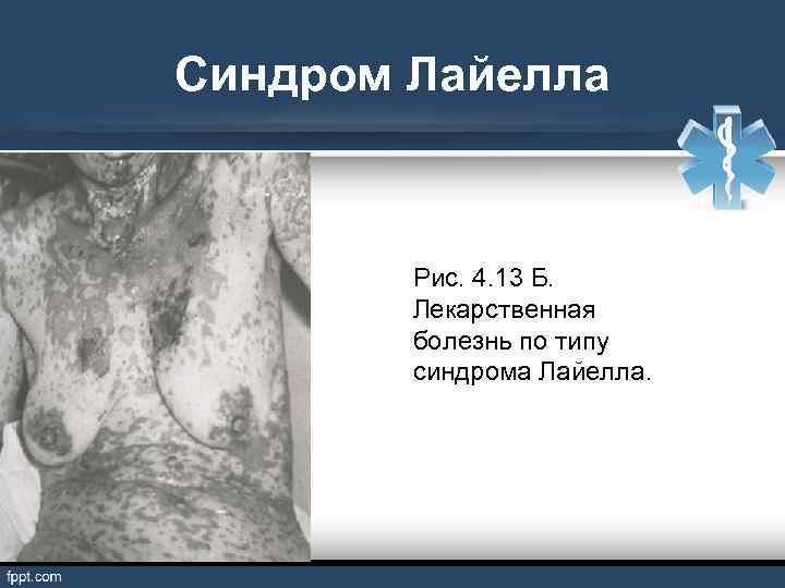 Синдром Лайелла Рис. 4. 13 Б. Лекарственная болезнь по типу синдрома Лайелла. 