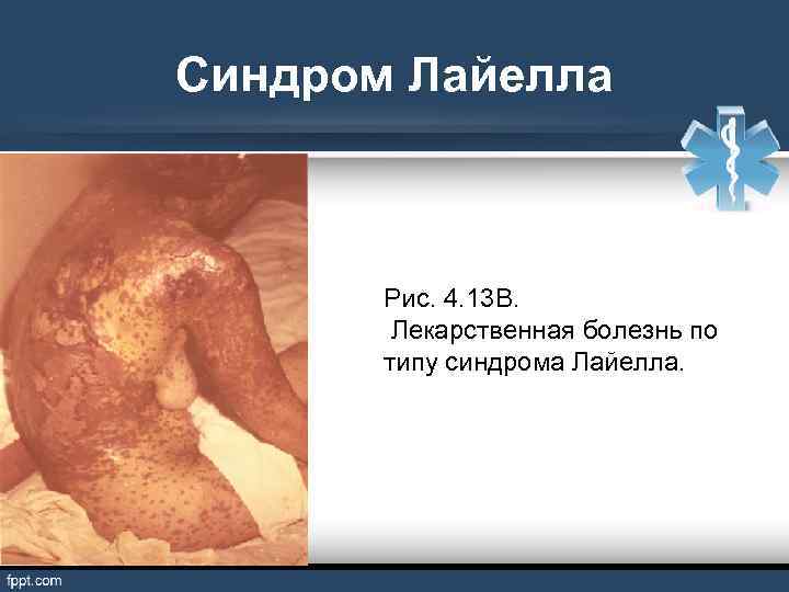 Синдром Лайелла Рис. 4. 13 В. Лекарственная болезнь по типу синдрома Лайелла. 