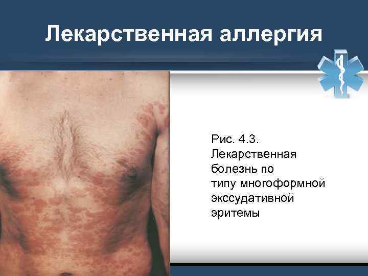 Лекарственная аллергия Рис. 4. 3. Лекарственная болезнь по типу многоформной экссудативной эритемы 