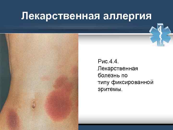 Лекарственная аллергия Рис. 4. 4. Лекарственная болезнь по типу фиксированной эритемы. 