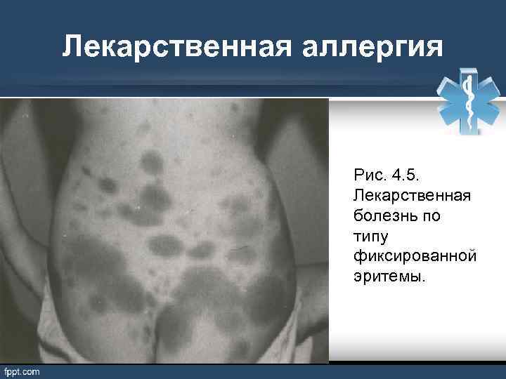 Лекарственная аллергия Рис. 4. 5. Лекарственная болезнь по типу фиксированной эритемы. 