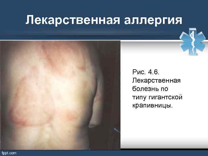 Лекарственная аллергия Рис. 4. 6. Лекарственная болезнь по типу гигантской крапивницы. 