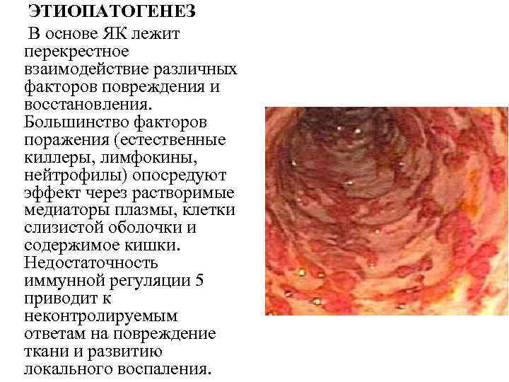 ЭТИОПАТОГЕНЕЗ В основе ЯК лежит перекрестное взаимодействие различных факторов повреждения и восстановления. Большинство факторов