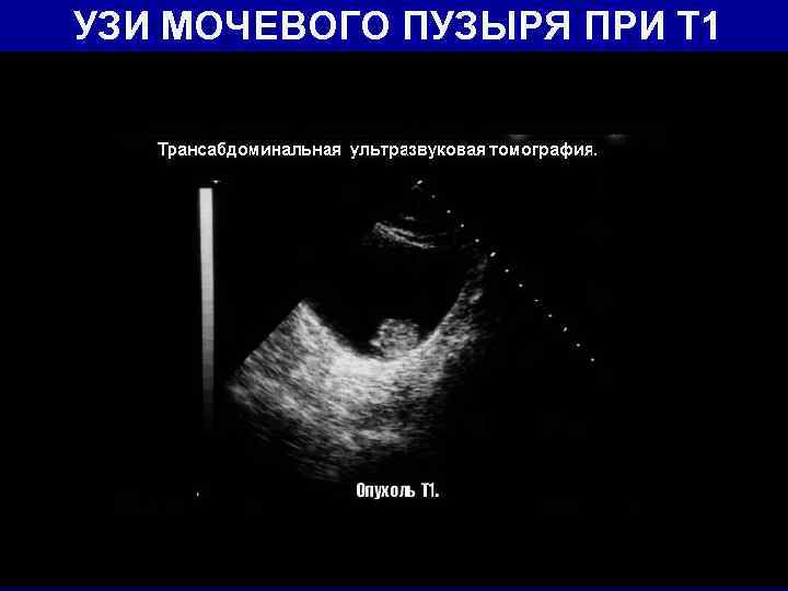 Трансабдоминальное УЗИ мочевого пузыря. Стриктура мочевого пузыря УЗИ. Онкология мочевого пузыря на УЗИ.