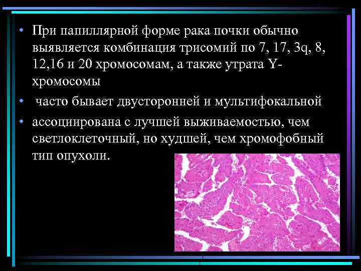  • При папиллярной форме рака почки обычно выявляется комбинация трисомий по 7, 17,