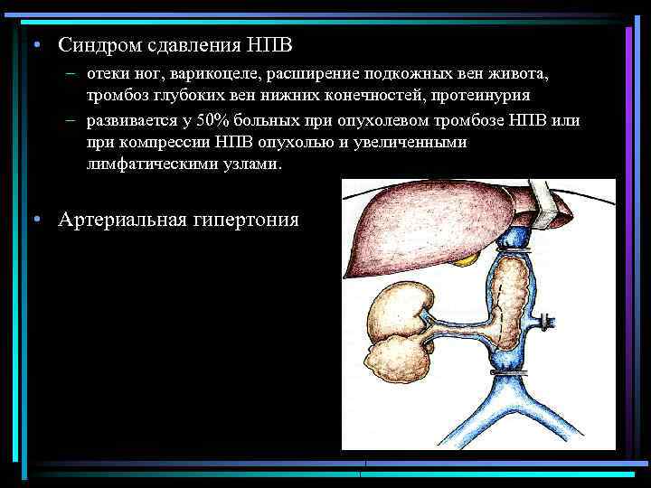  • Синдром сдавления НПВ – отеки ног, варикоцеле, расширение подкожных вен живота, тромбоз