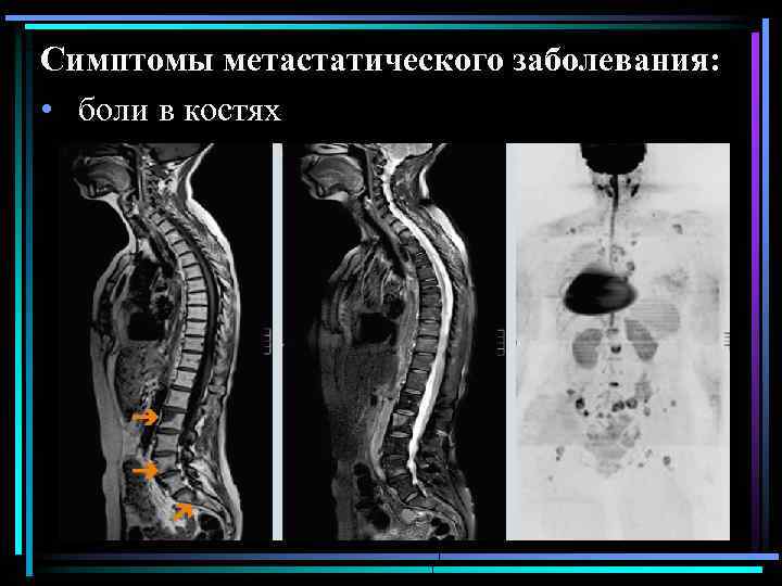 Симптомы метастатического заболевания: • боли в костях 